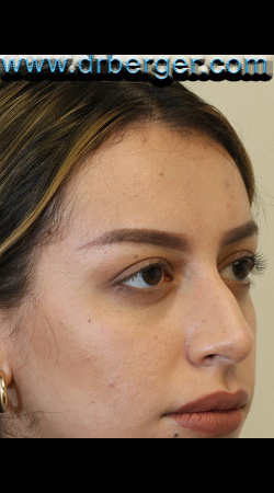 Before Image: Rhinoplasty (Nose Job) - right-front-oblique