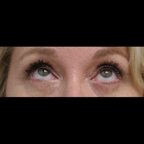 After Image: Upper Blepharoplasty, Lower Blepharoplasty and Endoscopic Brow Lift - other