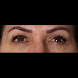 Before Image: Upper Blepharoplasty, Lower Blepharoplasty and Endoscopic Brow Lift