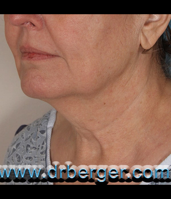 Before Image: Face/Neck Lift - left-front-oblique
